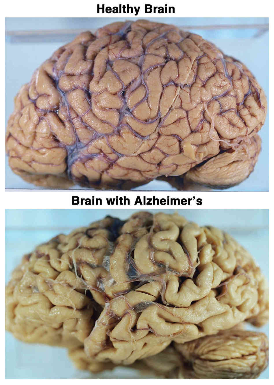 8 Different types of dementia