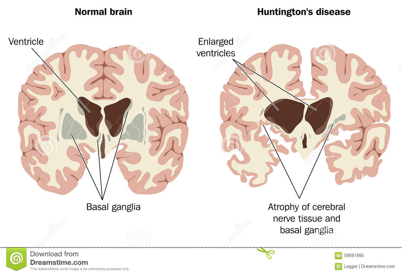 8 Different types of dementia